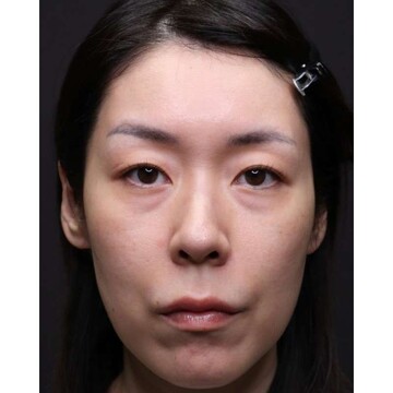 聖心美容クリニックの目元の症例写真[ビフォー]