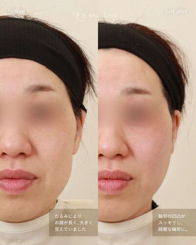 糸リフト（SAI LIFT TRY）18本の症例写真