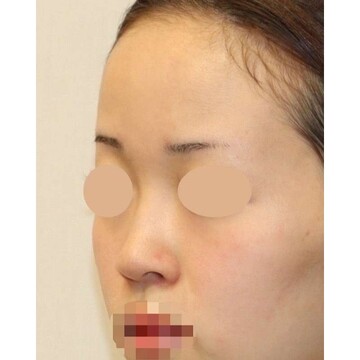 聖心美容クリニックの鼻の症例写真[ビフォー]