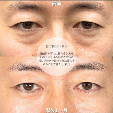 アリエル美容クリニック 大宮院の目元・クマ・眉下・涙袋整形の症例写真