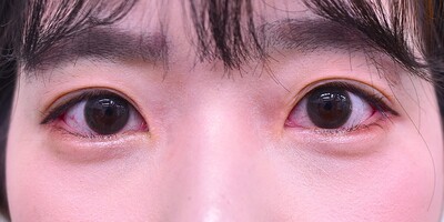 30代　女性　目尻切開　W法　　2.5㎜幅の症例写真[アフター]