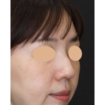 聖心美容クリニックの鼻の症例写真[ビフォー]
