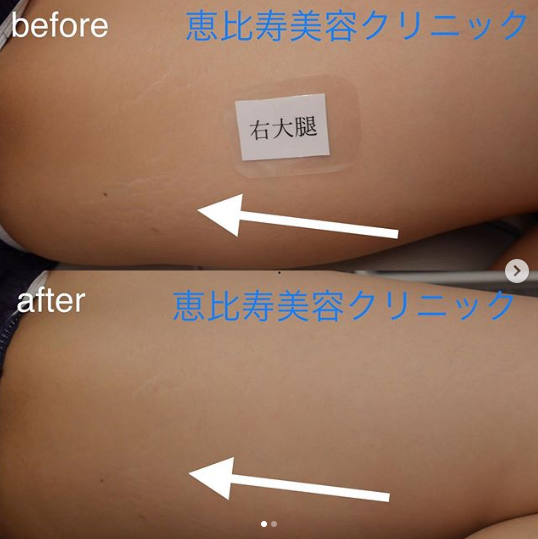太ももの肉割れ治療 (肉割れ・妊娠線の治療の症例写真・画像) 恵比寿美容クリニック (CS48633)《美容医療の口コミ広場》