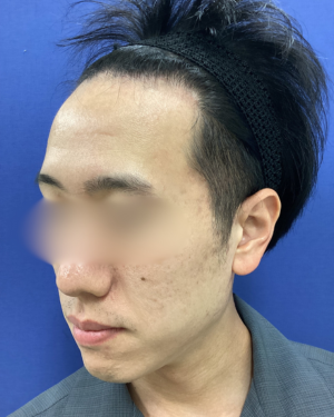 フェミークリニックの症例写真[アフター]