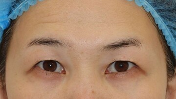 すなおクリニックの目・二重整形の症例写真[ビフォー]
