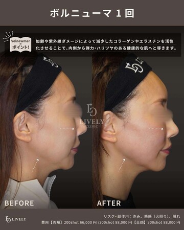 LIVELY CLINIC 浜松町院のしわ・たるみ整形(注入、糸、フェイスリフト)の症例写真