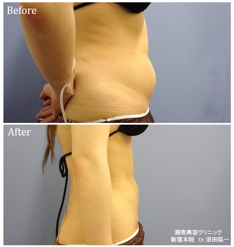 須田医師による脂肪吸引 脂肪吸引手術の症例写真 画像 湘南美容クリニック 新宿本院 Cs406 美容医療の口コミ広場