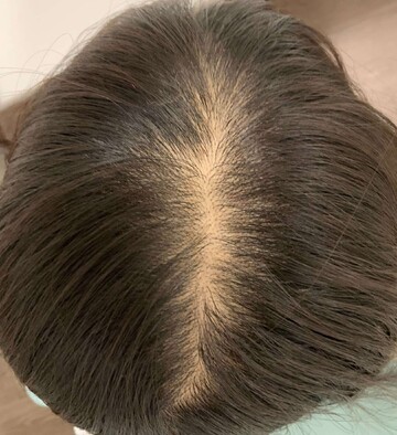 リアスクリニック 銀座院の薄毛治療の症例写真[ビフォー]