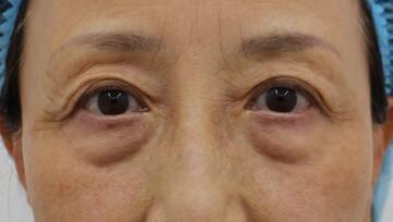 すなおクリニックの目元・クマ・眉下・涙袋整形の症例写真[ビフォー]
