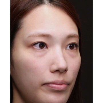 聖心美容クリニックの目元の症例写真[ビフォー]
