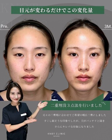 KNOT CLINIC AOYAMAの二重の症例写真