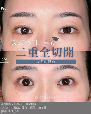 KNOT CLINIC AOYAMAの二重の症例写真
