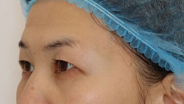すなおクリニックの目・二重整形の症例写真[ビフォー]