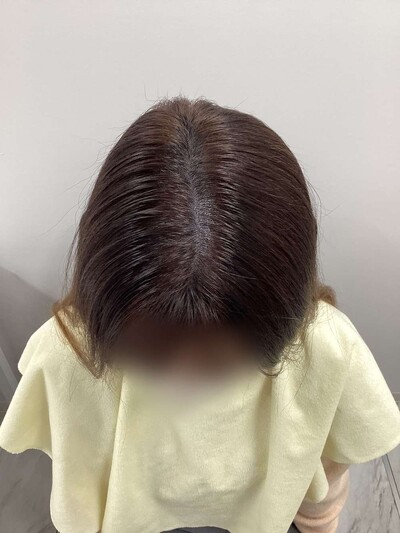 ヘアアートメイク｜20代｜2回の症例写真[アフター]