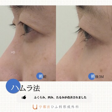 宇都宮ひふ科形成外科の目元・クマ・眉下・涙袋整形の症例写真