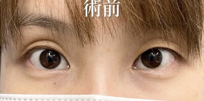 福山医師によるフォーエバー二重術の症例写真[ビフォー]