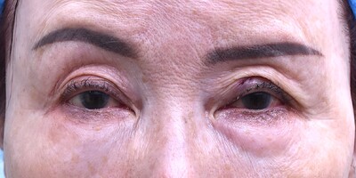 60代　女性　左中切開＋挙筋短縮　くぼみ目＋眼瞼下垂の症例写真[アフター]