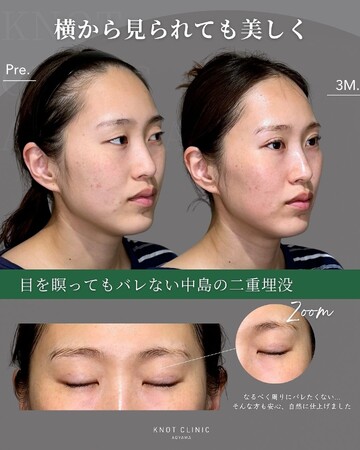 KNOT CLINIC AOYAMAの二重の症例写真