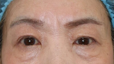 眉下切開+埋没法３点留めの症例写真[アフター]