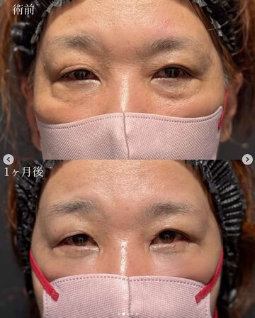 CLINIC Wの目元・クマ・眉下・涙袋整形の症例写真