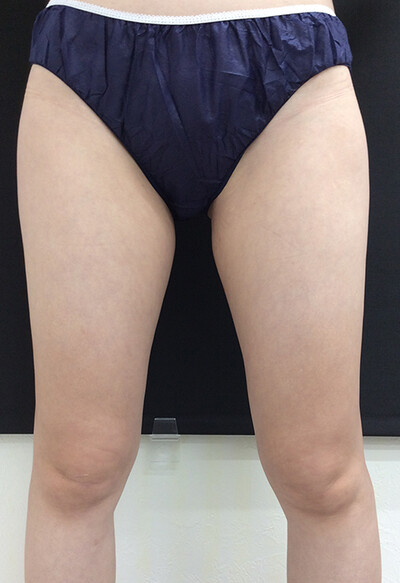 切らない脂肪吸引 リポセル で部分痩せ 太もも 膝上 メソセラピー 脂肪溶解注射 その他 メディカルダイエット 太もも痩せ ダイエット 顔痩せ Bnls注射 の症例写真 画像 いろはビューティークリニック Cs 美容医療の口コミ広場