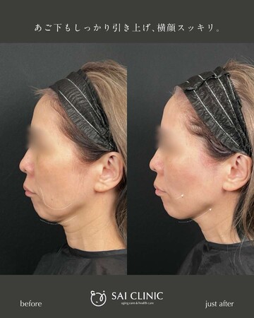 SAI CLINIC （サイクリニック）のリフトアップの症例写真