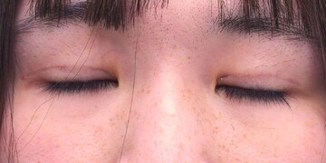 医療法人秀晄会 心斎橋コムロ美容外科クリニックの症例写真[アフター]