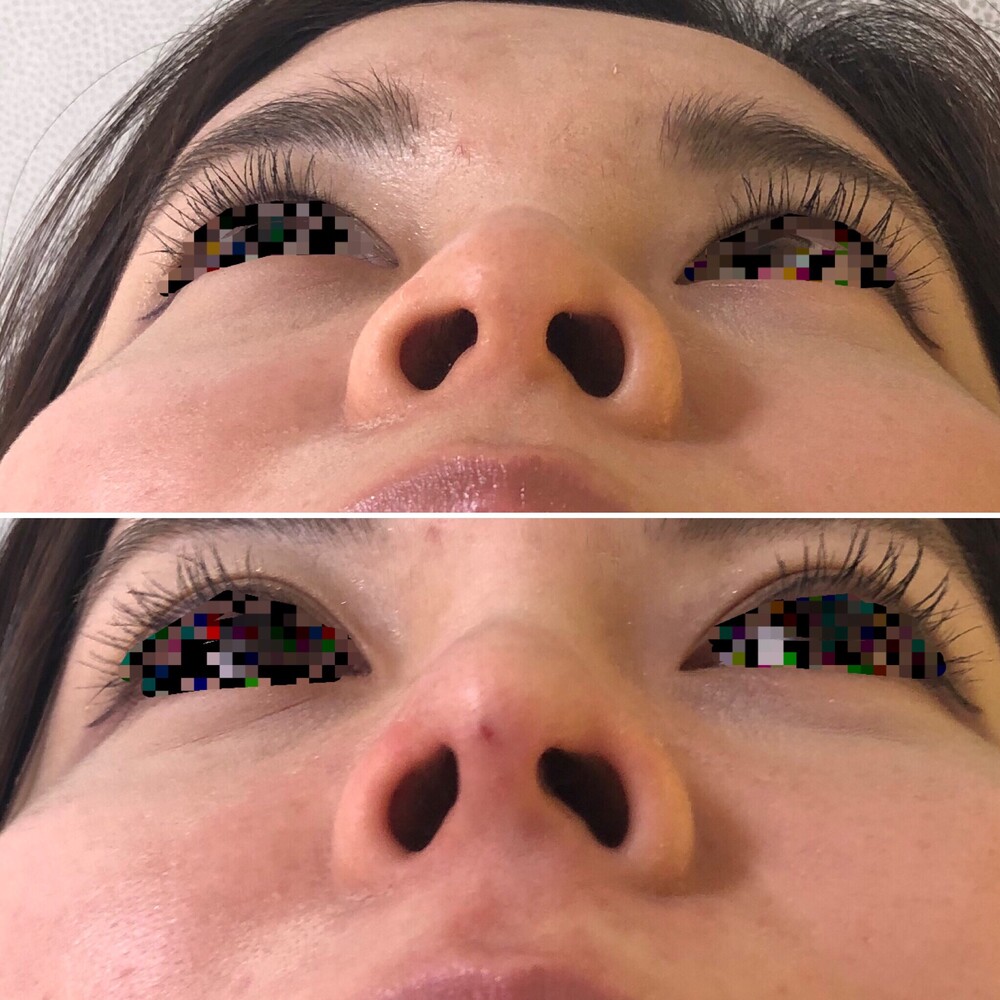 鼻筋ほっそり 鼻さきもツンと その他 顔のしわ たるみ の症例写真 画像 ビューティークリニック ザ ギンザ Cs 美容医療の口コミ広場