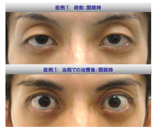 上瞼のクボミを伴う眼瞼下垂を切らずに改善 (二重埋没法、眼瞼下垂、その他（二重整形）の症例写真・画像) - KUNOクリニック 麻布院 ...