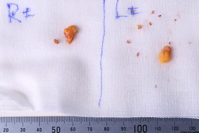 20代　男性　上まぶたの脂肪取り　（埋没法は行なわず）の症例写真