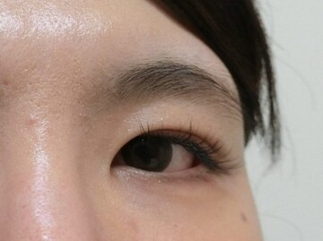やさしい美容皮膚科・皮フ科 東京浅草院／シミレーザークリニックの目元・クマ・眉下・涙袋整形の症例写真[ビフォー]