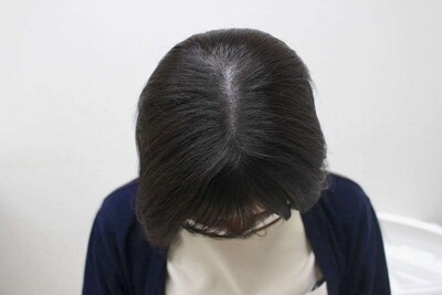 ヘアアートメイク｜20代｜2回の症例写真[アフター]