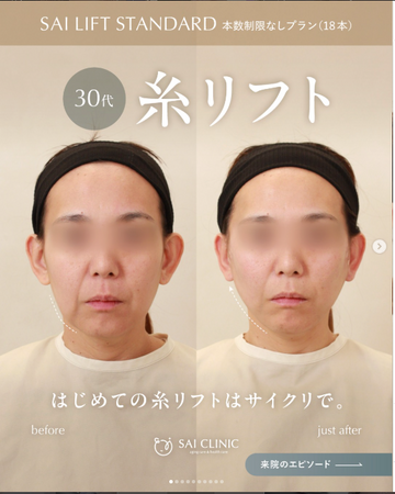 SAI CLINIC （サイクリニック）のリフトアップの症例写真