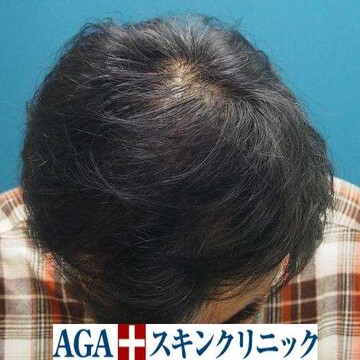 AGAスキンクリニックの症例写真[アフター]