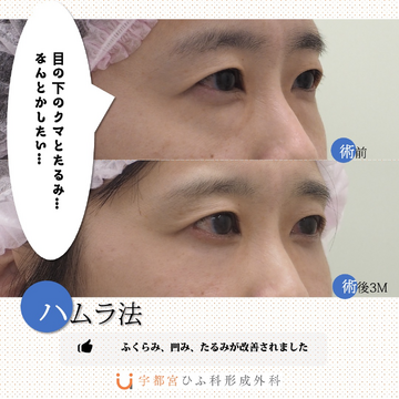 宇都宮ひふ科形成外科の目元・クマ・眉下・涙袋整形の症例写真