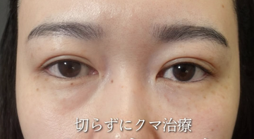 Plume Clinicの目元・クマ・眉下・涙袋整形の症例写真[ビフォー]