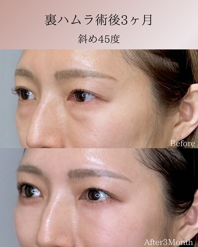 裏ハムラの症例写真