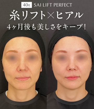 SAI CLINIC （サイクリニック）のリフトアップの症例写真