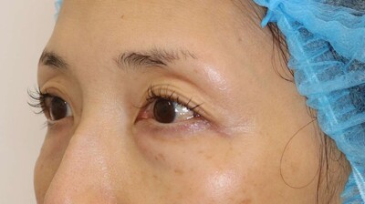 下瞼脱脂の症例写真[ビフォー]