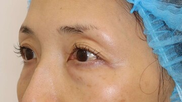 すなおクリニックの目元・クマ・眉下・涙袋整形の症例写真[ビフォー]