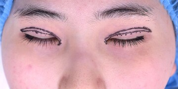 医療法人秀晄会 心斎橋コムロ美容外科クリニックの目・二重整形の症例写真[ビフォー]