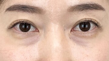 AI Beauty Clinicの目元・クマ・眉下・涙袋整形の症例写真[ビフォー]