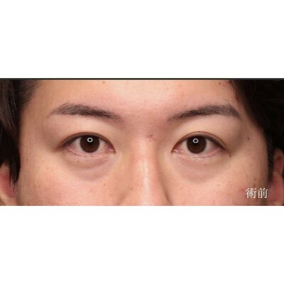 男性の裏ハムラ法で疲れ顔の目元を改善（術後3ヶ月）の症例写真[ビフォー]