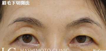 静岡美容外科橋本クリニックの目元・クマ・眉下・涙袋整形の症例写真[ビフォー]