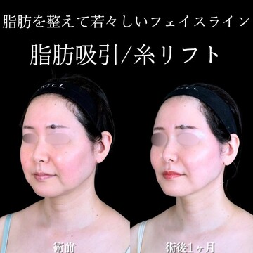 アリエル美容クリニック 大宮院の脂肪吸引の症例写真