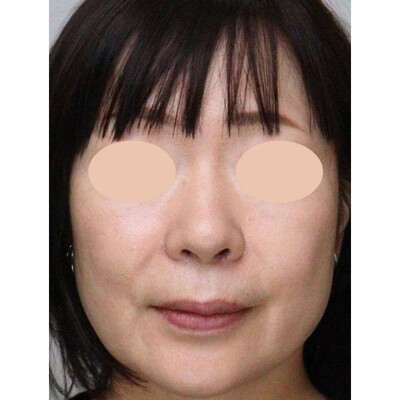 小鼻縮小（内側法＋外側法）で小鼻の広がりを改善の症例写真[アフター]