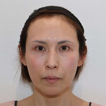 すなおクリニックのしわ・たるみ整形(注入、糸、フェイスリフト)の症例写真[ビフォー]