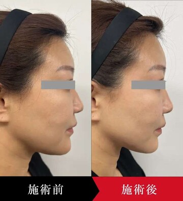 椿クリニックのHIFU・照射系リフトアップ治療の症例写真