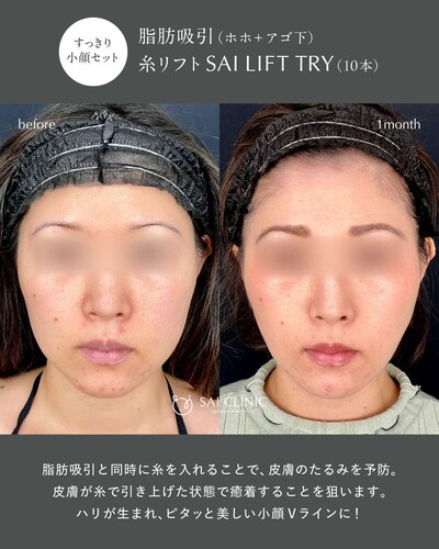 【30代】サクションリフト（脂肪吸引＋糸リフト）の症例写真