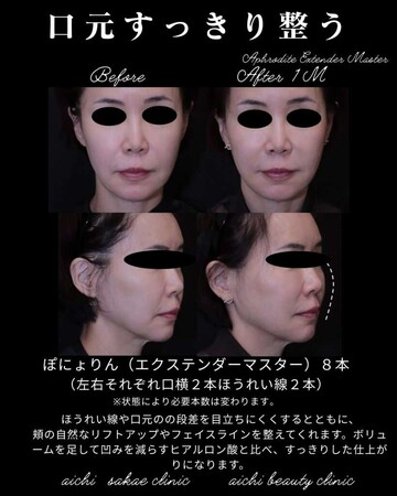 あいちビューティークリニック栄本院のリフトアップの症例写真